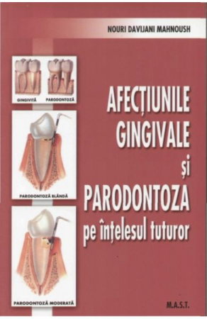 Sanatate - Afectiunile gingivale si paradontoza pe intelesul tuturor de Nouri Davijani Mahnoush