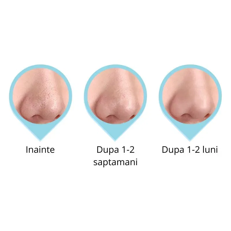 Dispozitiv de masaj pentru zona ochilor [5]