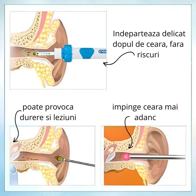 Dispozitiv electric curatarea urechilor [9]