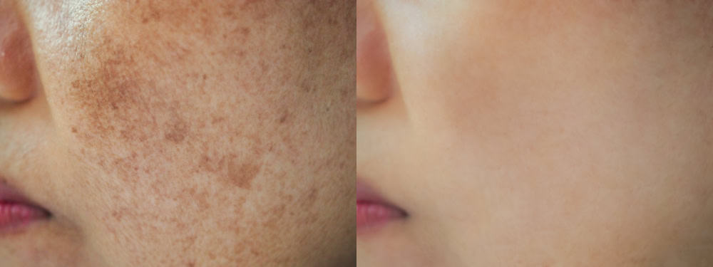 Care sunt beneficiile vitaminei C pentru piele cu pete pigmentare