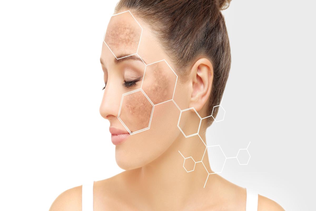 Melasma - ghid util pentru intelegerea si tratarea acestei afectiuni dermatologice