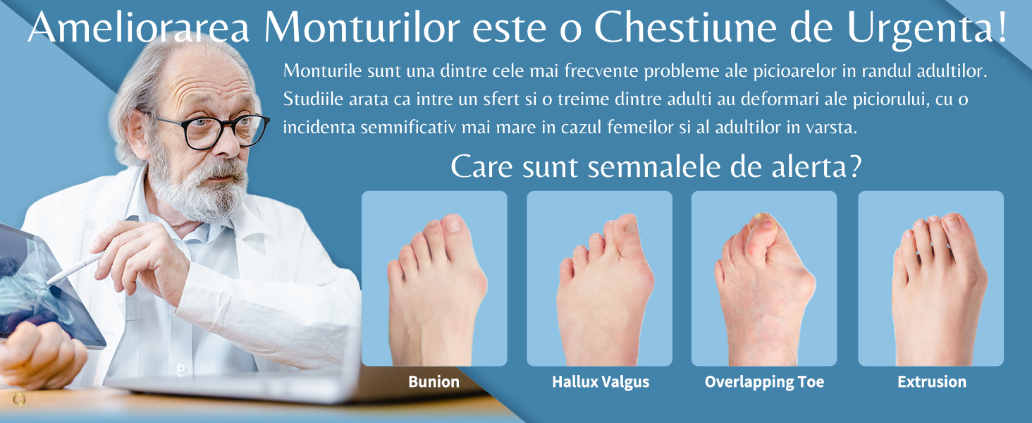 Hallux Valgus: Cauze, Simptome, Ghid de Tratament cu noile Corectoare de Monturi