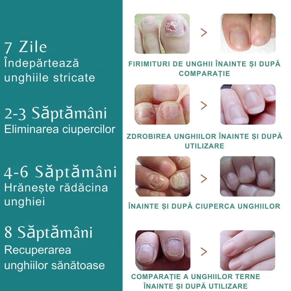 Aparat cu Laser pentru Indepartarea Onicomicozei si Tratarea Ciupercilor de Unghii, Portabil, Reancarcabil, Alb [17]