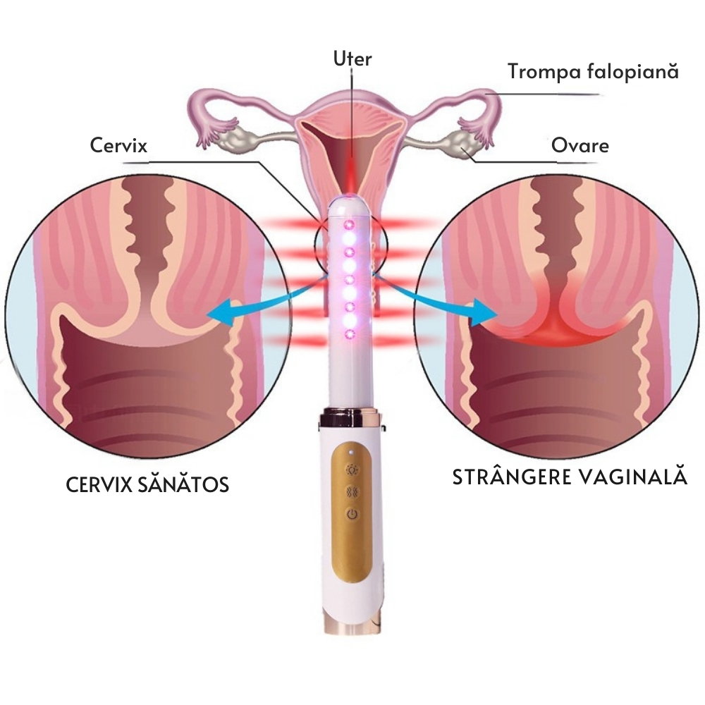 Bagheta Ginecologica cu Laser si Vibratii pentru Sanatatea Vaginala [23]