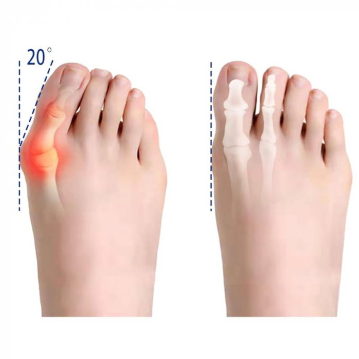 Corector Monturi Hallux Valgus Ajustabil – Deget [15]