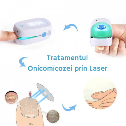 Aparat cu Laser pentru Indepartarea Onicomicozei si Tratarea Ciupercilor de Unghii, Portabil, Reancarcabil, Alb [13]