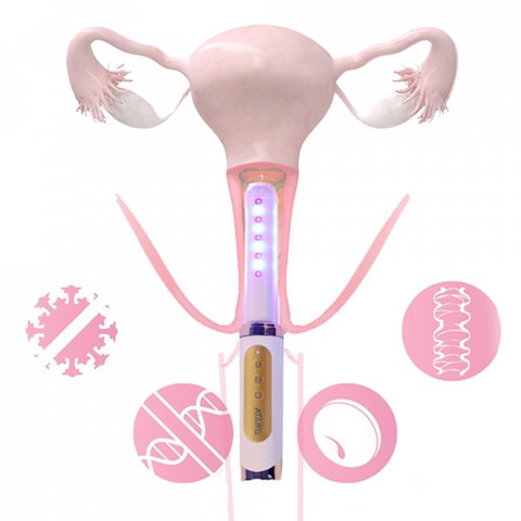 Bagheta Ginecologica cu Laser si Vibratii pentru Sanatatea Vaginala [3]