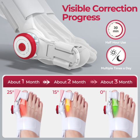 Corector monturi copii reglabil 3D pentru Hallux Valgus [4]