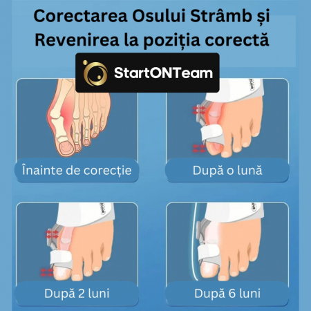 Corector Monturi Hallux Valgus Ajustabil – Deget [19]