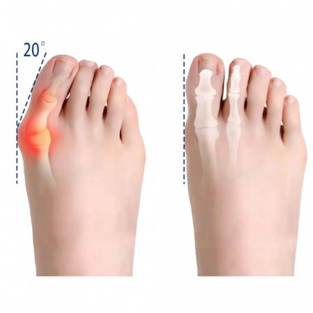 Corector Monturi Hallux Valgus Ajustabil – Deget [14]